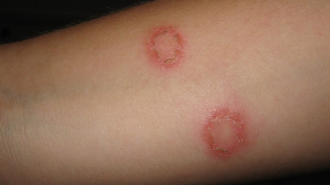 Exemple de ringworm (teigne) sur le bras